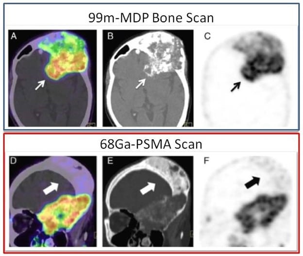 Is there a future for PSMA theranostics in Osteosarcoma?, Isotopia Molecular Imaging Ltd